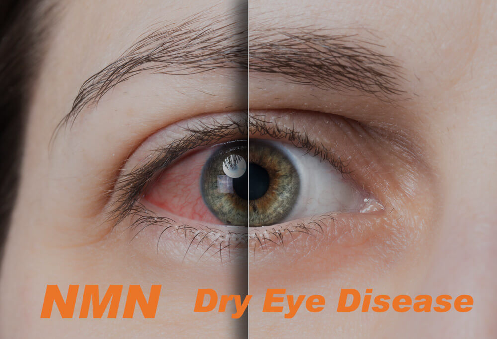 NMN dry eye disease